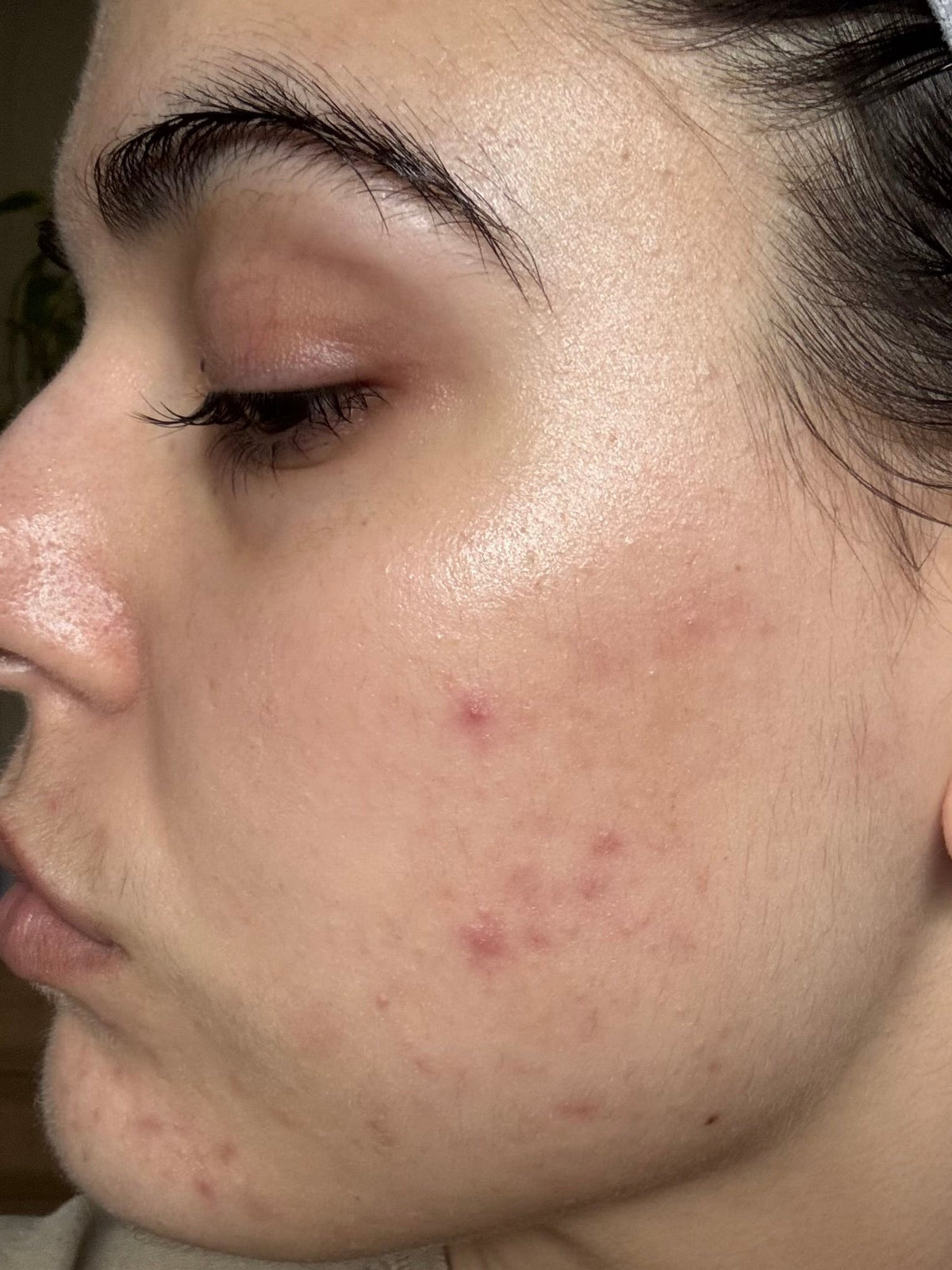 After skincare result